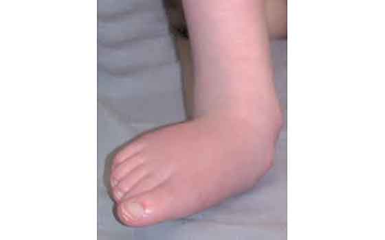 flat foot sole