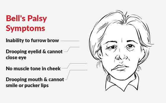 Symptoms of Bell’s palsy