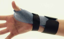 Quervain’s tendinosis