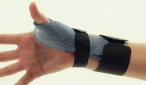 Quervain’s tendinosis