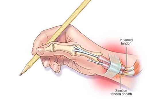 Quervains tendinosisis
