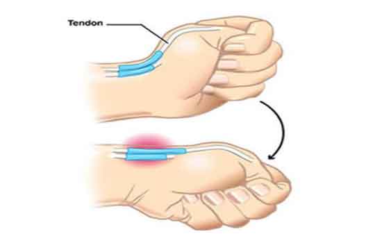 Tendon